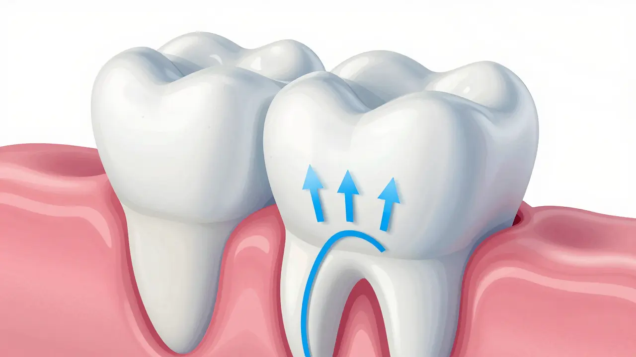 Schéma zubu ukazující pronikání peroxidu do dentinu